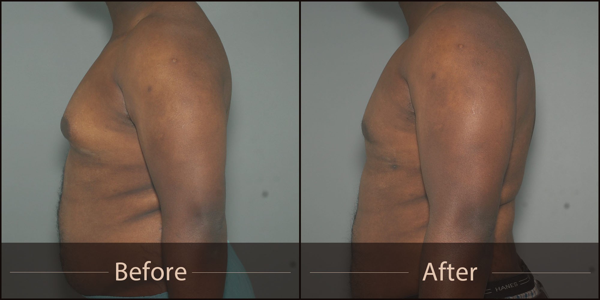 Gynecomastia Before and After Image