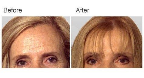 Brow Lift Before and After - Female Patient 2 Brow Lift Before and After | Vincent N. Zubowicz, MD