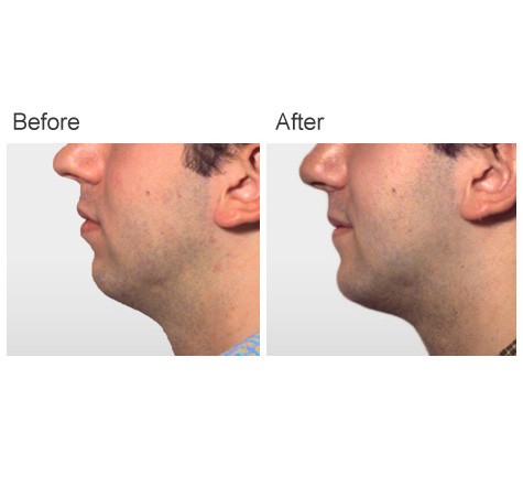 Cheek and Chin Implants Before and After Photos - Male Patient 3 Cheek Implants Before and After | Chin Implant Before and After