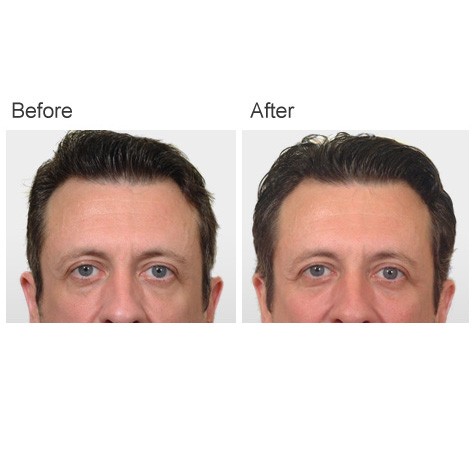 Cheek and Chin Implants Before and After Photos - Male Patient 4