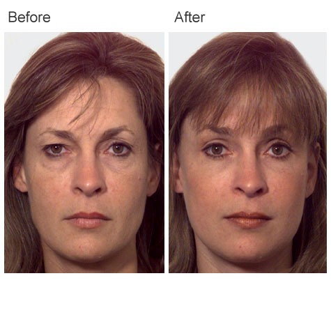 Facelift Surgery Before and After Photos - Female Patient 1