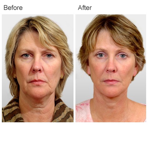 Facelift Surgery Before and After Photos - Female Patient 3