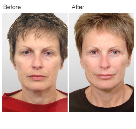 Facelift Surgery Before and After Photos - Female Patient 13