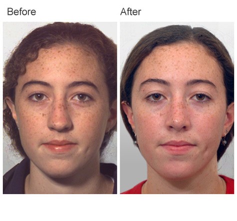 Rhinoplasty Before and After Pictures - Female Patient 12