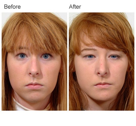 Rhinoplasty Before and After Pictures - Female Patient 19