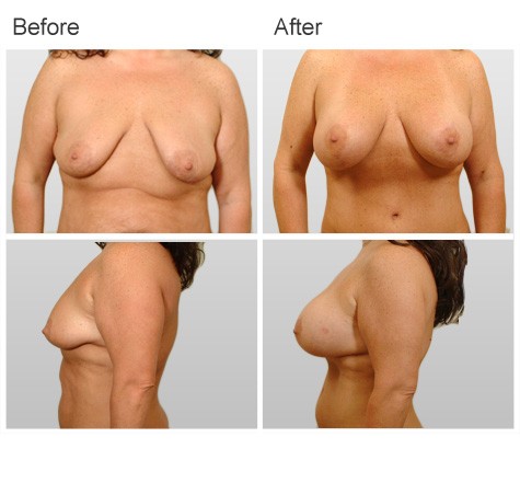 Before and After Photos for Mastopexy Surgery for Breast Reshaping