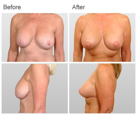 Before and After Photos for Mastopexy Surgery for Breast Reshaping