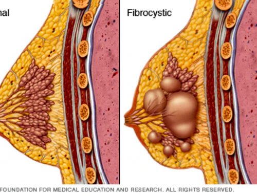 What Is Fibrocystic Breast Disease?