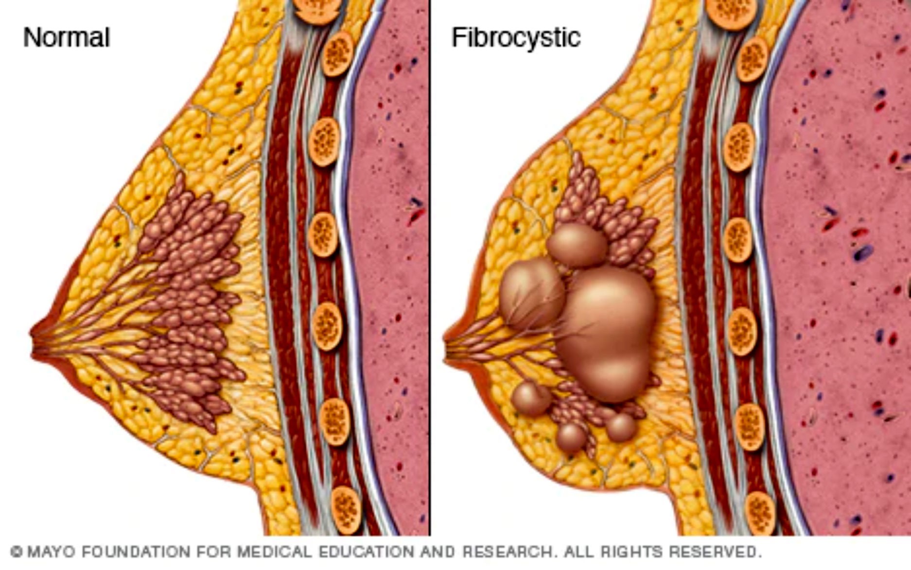 What Is Fibrocystic Breast Disease