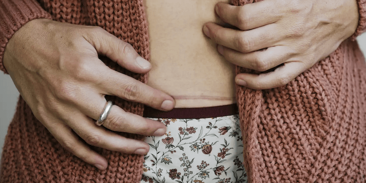 Woman With Scar on Her Stomach