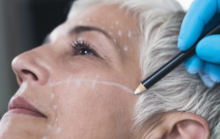 Close Up of Older Woman's Face and Lines Drawn for Surgery