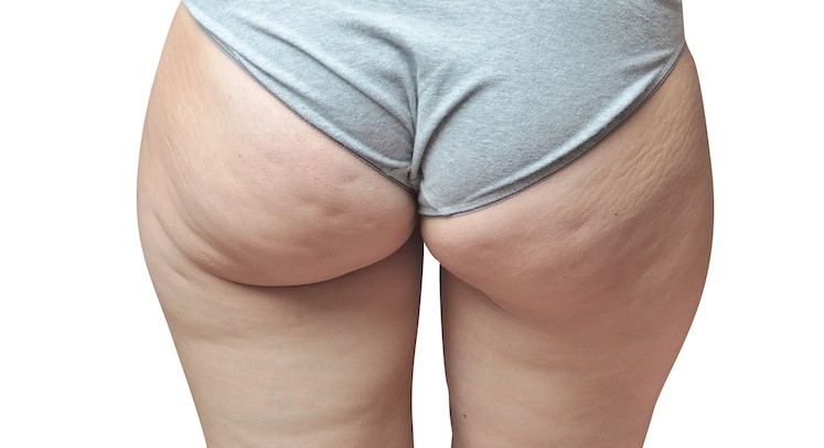 Woman's Butt and Thighs With Cellulite