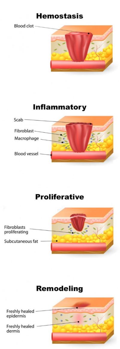 Illustration of Hemostasis, Inflammatory, Proliferative, Remodeling Skin
