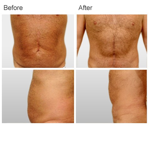 Abdominoplasty Before and After Photos - Patient 09