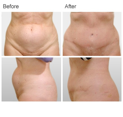 Abdominoplasty Before and After Photos - Patient 10