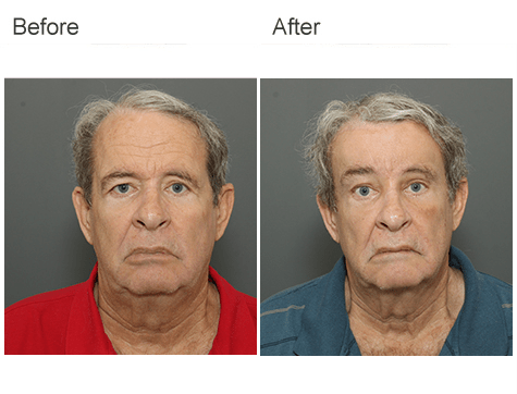 Male Brow Lift Before and After Photos Brow Lift Before and After | Vincent N. Zubowicz, MD