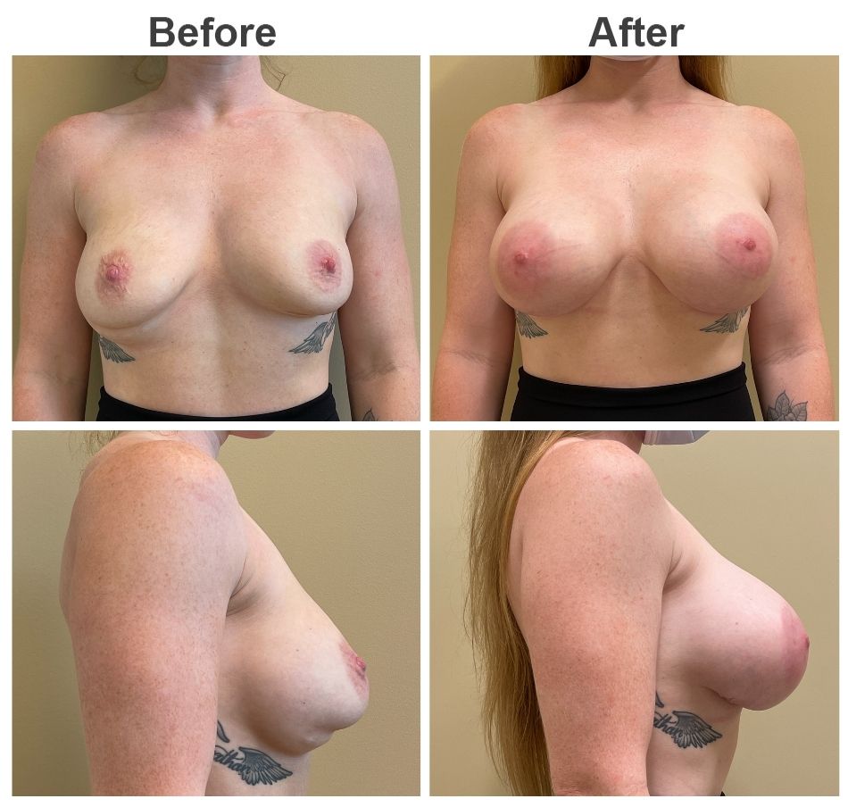 27 year old pre and post op secondary breast augmentation
