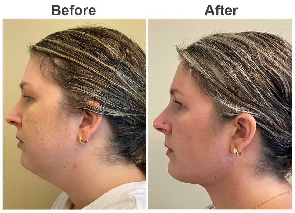 33 year old female patient before and one month after liposuction of the neck
