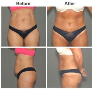 42-Year-Old Tummy Tuck and Liposuction Before and After