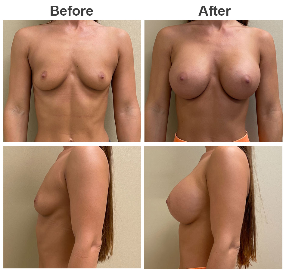 445cc Breast Augmentation Before and After.