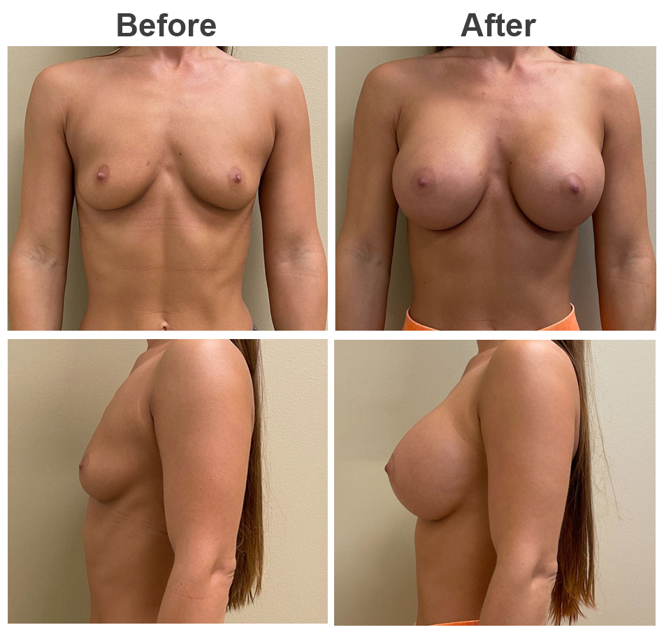 445cc Breast Augmentation Before and After