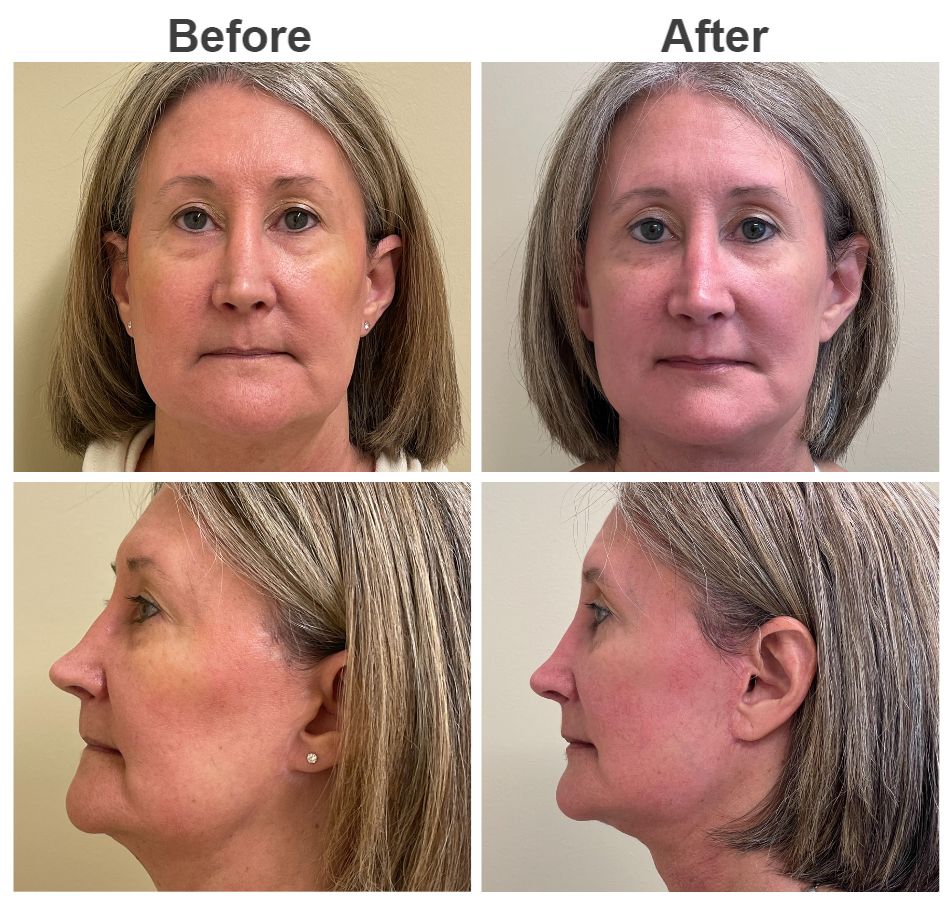 60 year old female 3 months post composite facelift and structural fat grafting Facelift Before and After | Vincent N. Zubowicz, MD