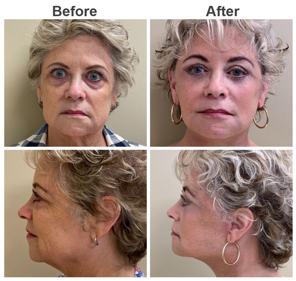 66 year old female before and after composite facelift and lower eyelid surgery Facelift Before and After | Vincent N. Zubowicz, MD