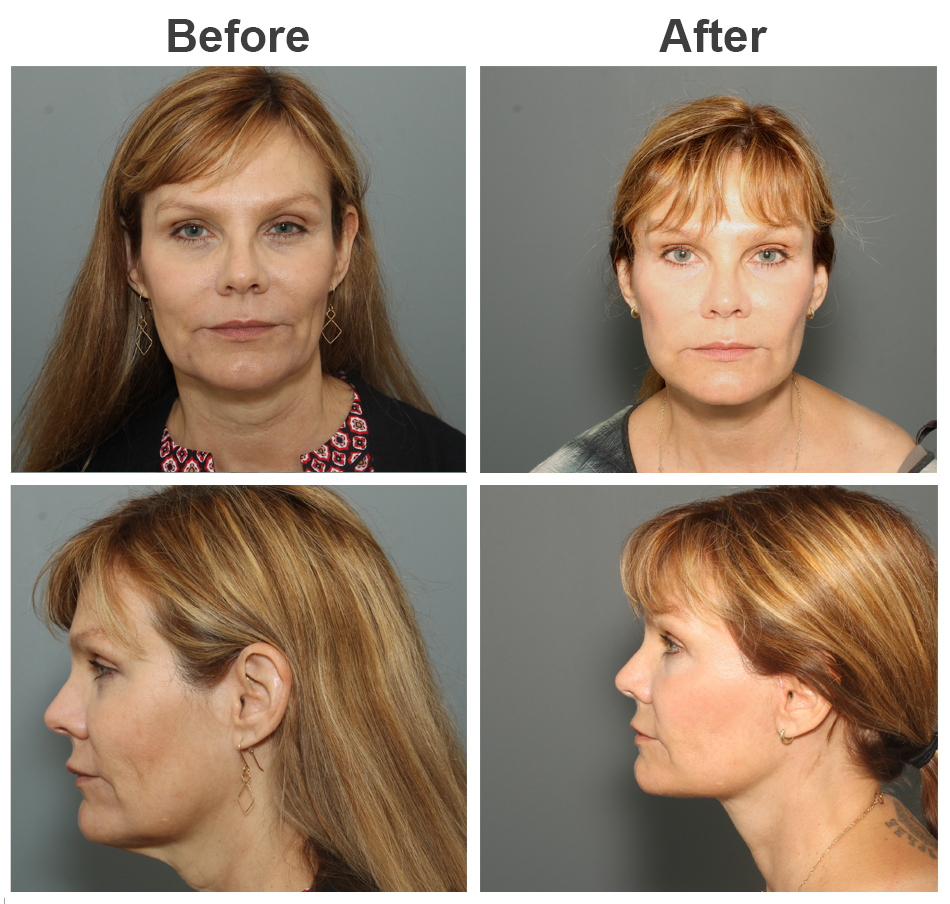 8 Facelift Before-and-After Photos That Prove Just How Natural