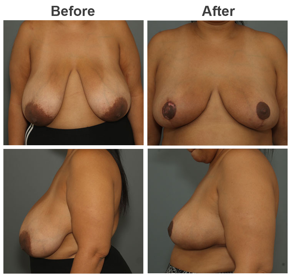 Before and After of Breast Reduction and Lift