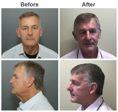 Male-Facelift-Before-and-After-Photos