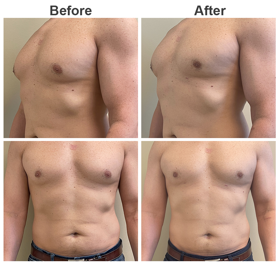 Gynecomastia Before & After, Case 10