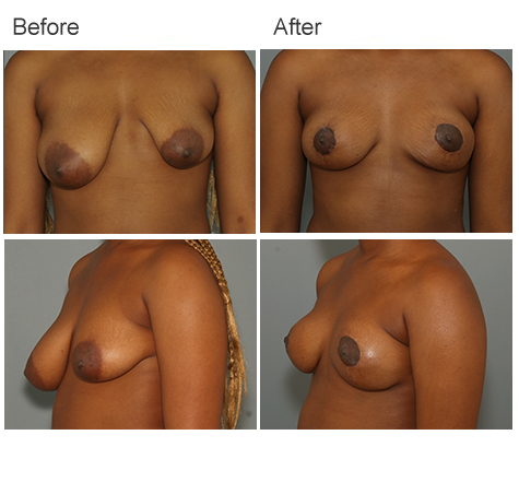 Before and After Photos of Bilateral Mastopexy With Small Reduction to Correct Asymmetry