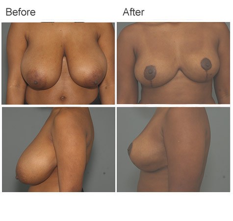 Bilateral Breast Reduction Before and After Photos
