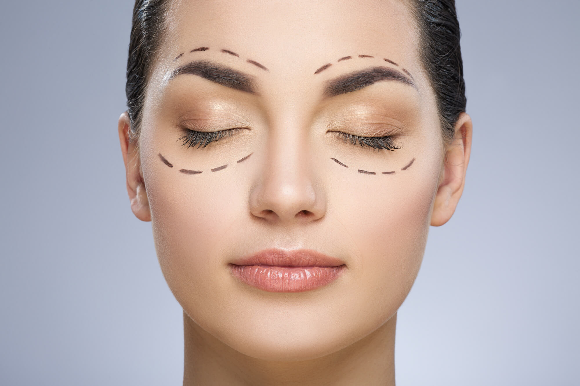 Woman's Face With Lines Drawn for Eyelid Surgery Plastic Surgery Before and After | Vincent N. Zubowicz, MD
