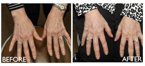 Before and After Photos of a Woman's Hands After Fat Transfer
