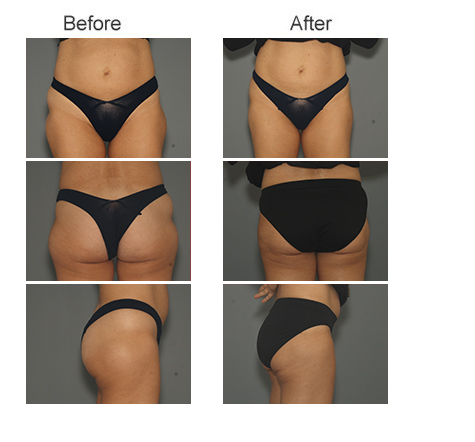 Before and After Photos of Thigh Liposuction on 36-Year-Old Female Patient