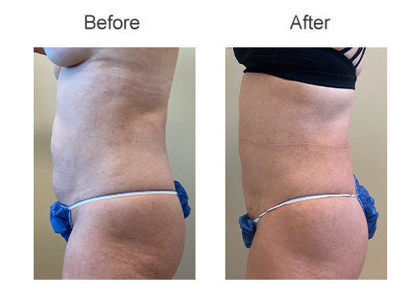 liposuction abdomen before after