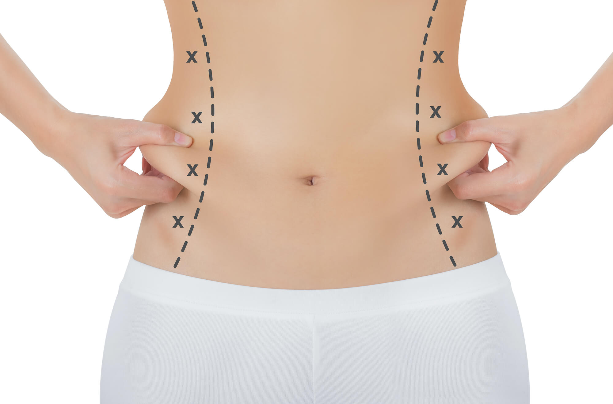 Woman's Abdomen With Lines Drawn for Liposuction Surgery Plastic Surgery Before and After | Vincent N. Zubowicz, MD