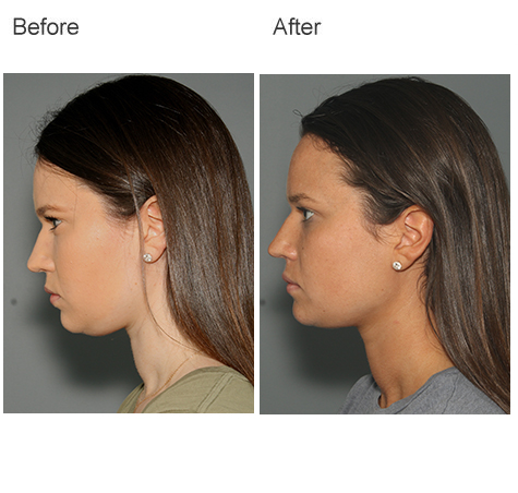 Face Liposuction Before And After