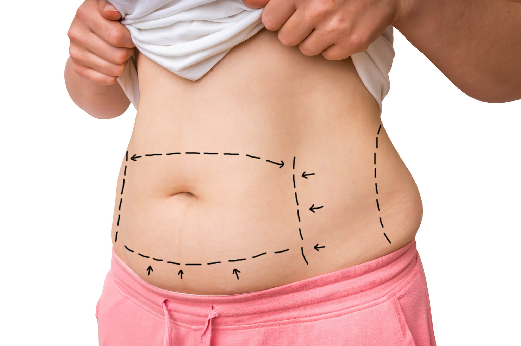 Woman With Lines on Her Stomach to Prep for Tummy Tuck Surgery Plastic Surgery Before and After | Vincent N. Zubowicz, MD
