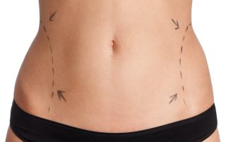 Female Abdomen With Lines Drawn for Surgery Prep