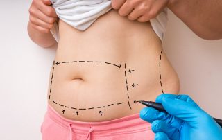 Lines Drawn on Woman's Abdomen for Tummy Tuck Surgery
