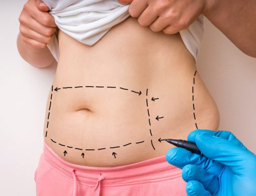 The Top Questions About Tummy Tucks
