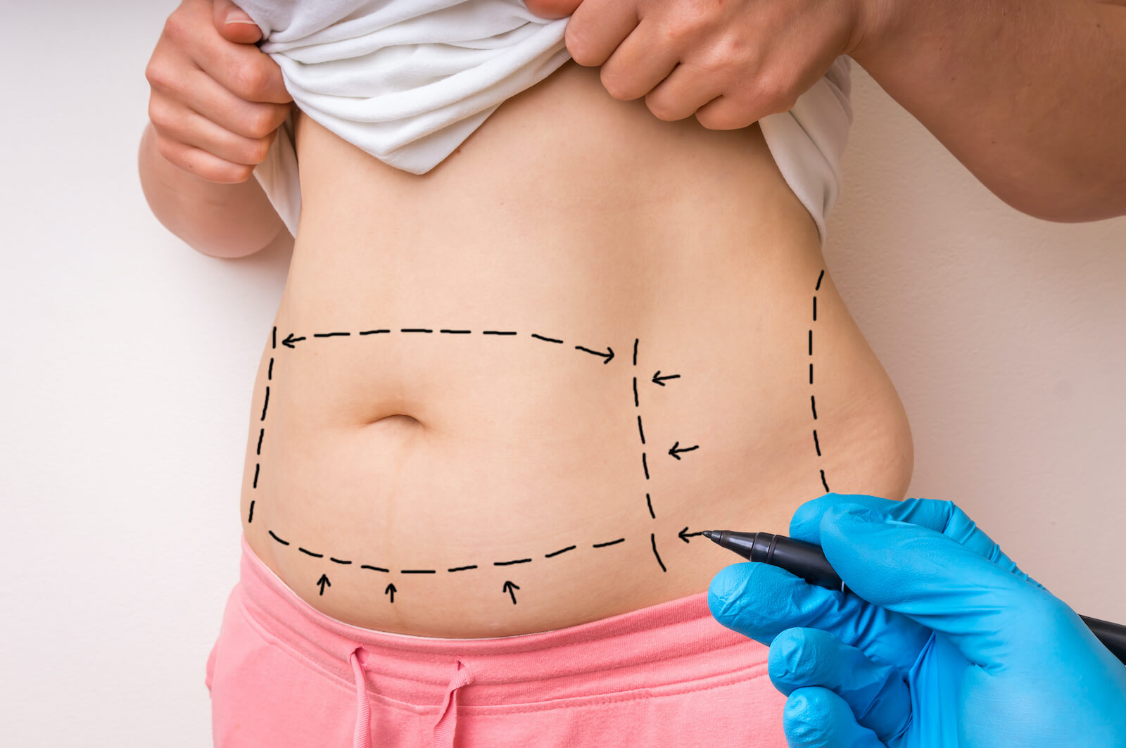 Lines Drawn on Woman's Abdomen for Tummy Tuck Surgery