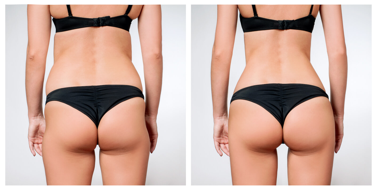 Liposuction Before and After Photo of Woman's Back, Butt, and Legs