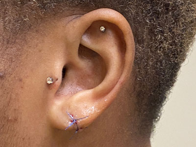 Ear-Lobe-Repair-After