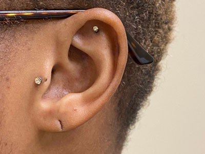 Ear-Lobe-Repair-Before