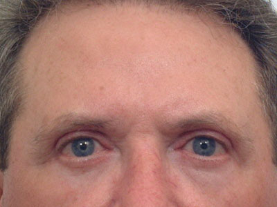Eyelid-Surgery-After