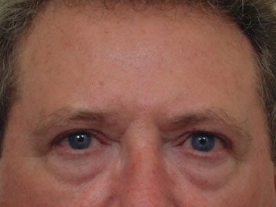 Eyelid-Surgery-Before