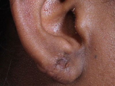Keloid-Removal-After